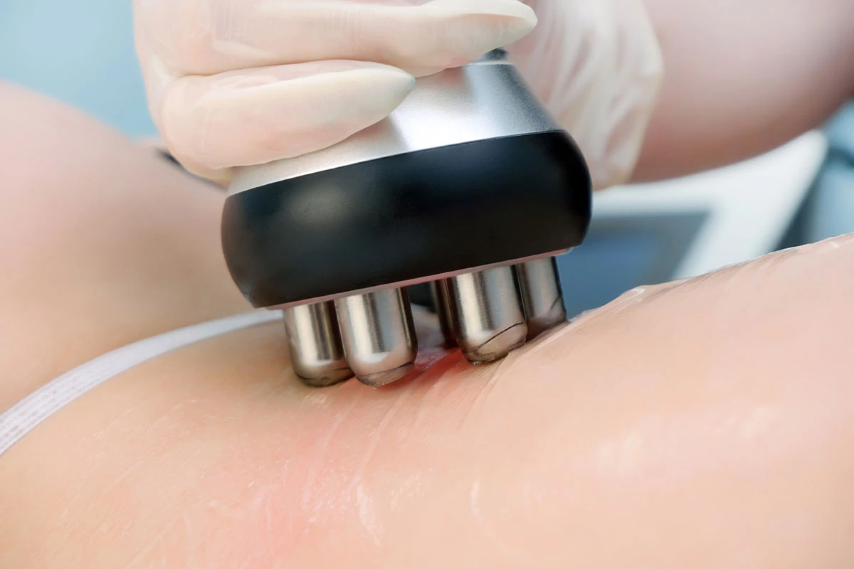 jak efektivně prezentovat proceduru rf liftingu klientům